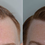 Hair Transplant Before and After Photos in Miami, FL, Patient 3468