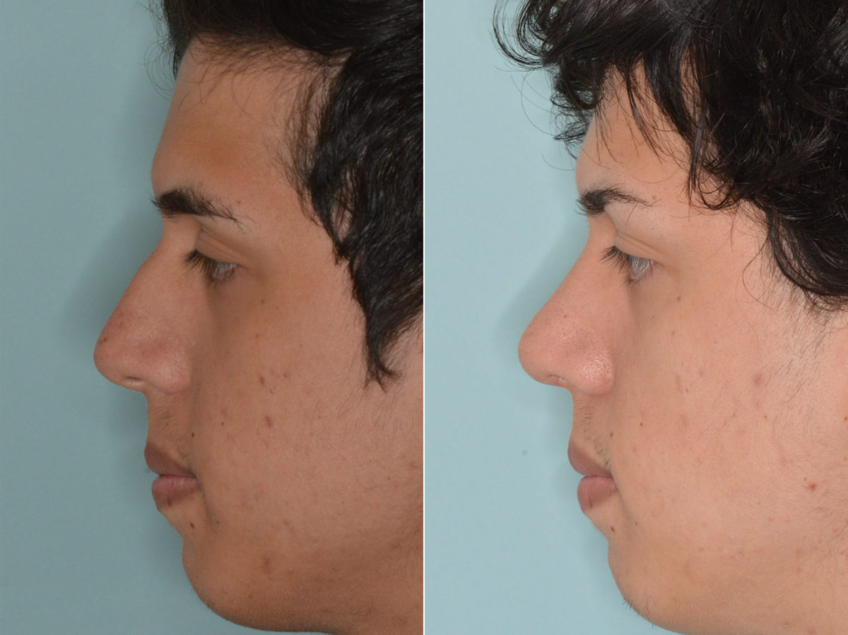 Rhinoplasty Before and After Photos in Miami, FL, Patient 3444