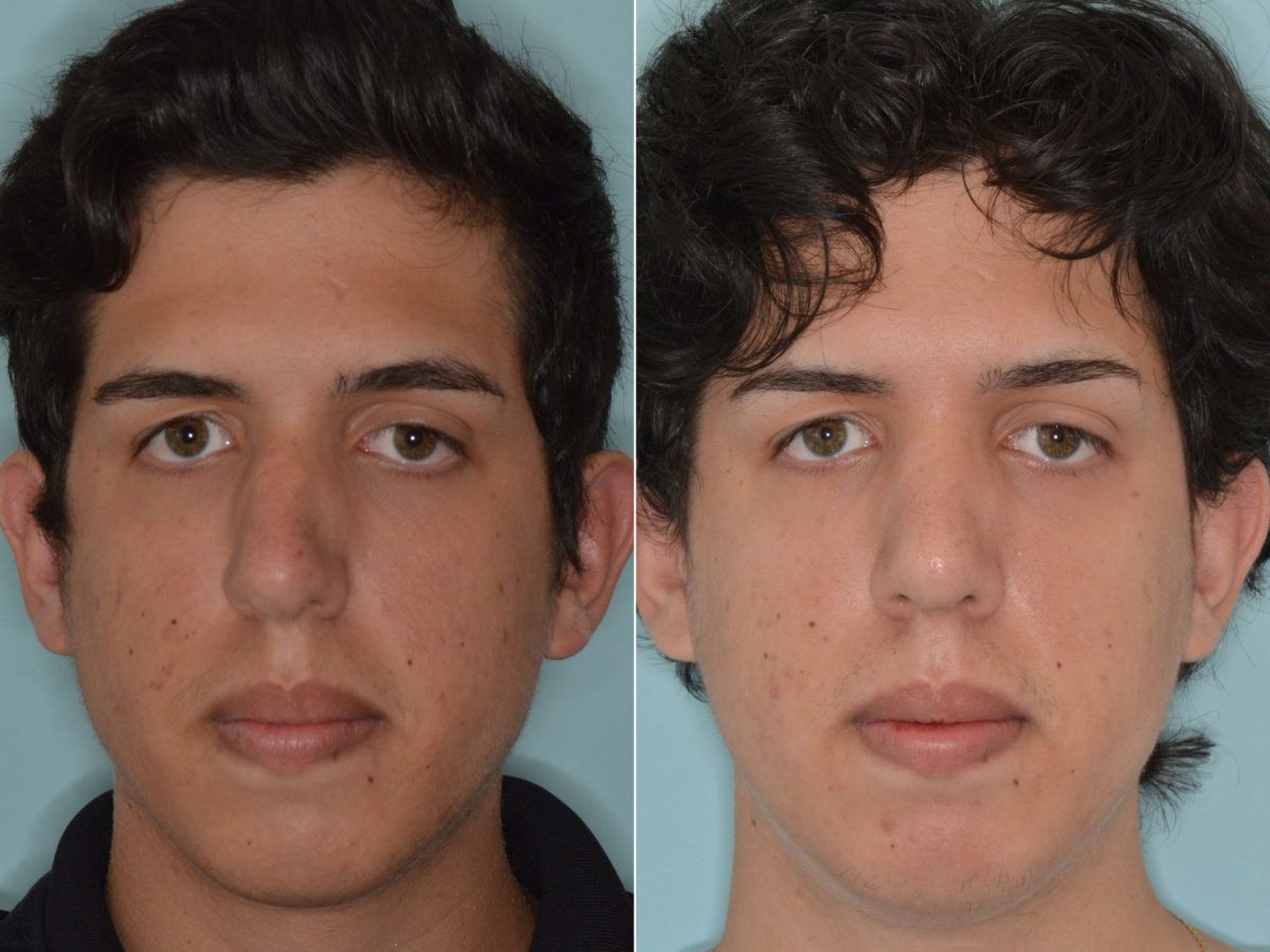 Rhinoplasty Before and After Photos in Miami, FL, Patient 3444