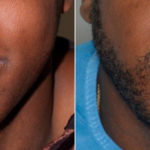 Hair Restoration Before and After Photos in Miami, FL, Patient 3531