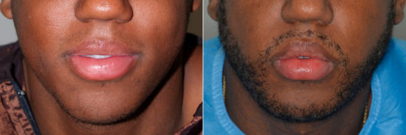 Hair Restoration Before and After Photos in Miami, FL, Patient 3531