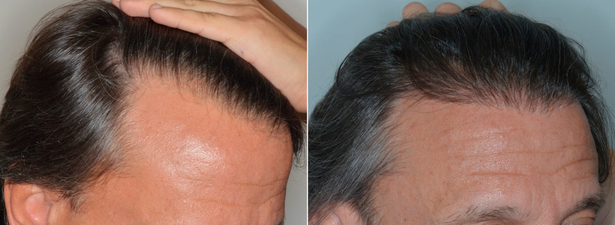 Hair Transplant Before and After Photos in Miami, FL, Patient 3508