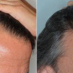 Hair Transplant Before and After Photos in Miami, FL, Patient 3508