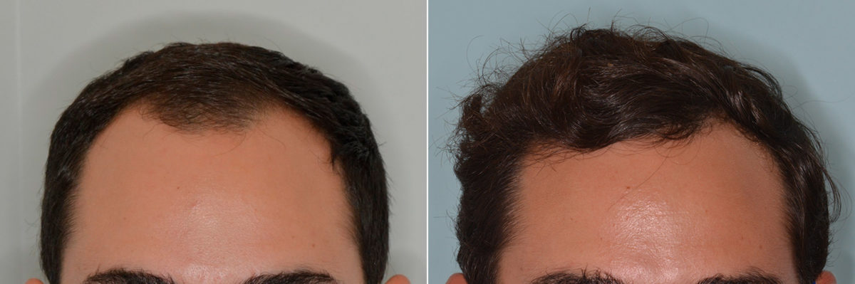 Hair Transplant Before and After Photos in Miami, FL, Patient 3629