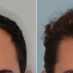 Hair Transplant Before and After Photos in Miami, FL, Patient 3629