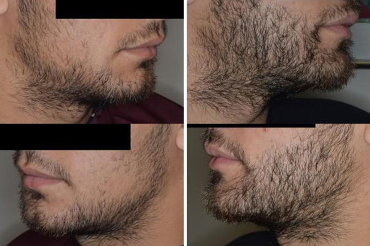 Beard Transplant | | Anthony Bared