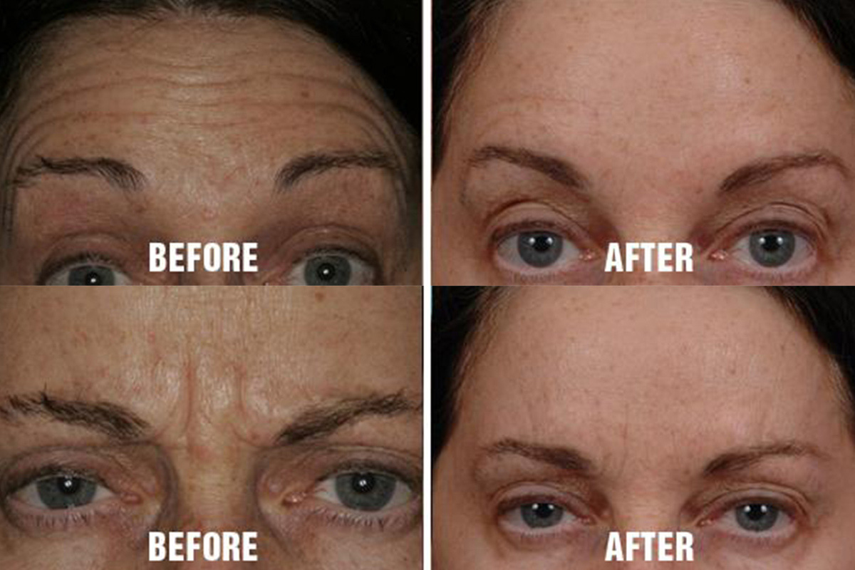 BOTOX Miami, FL BOTOX Injections in South Florida Dr. Bared