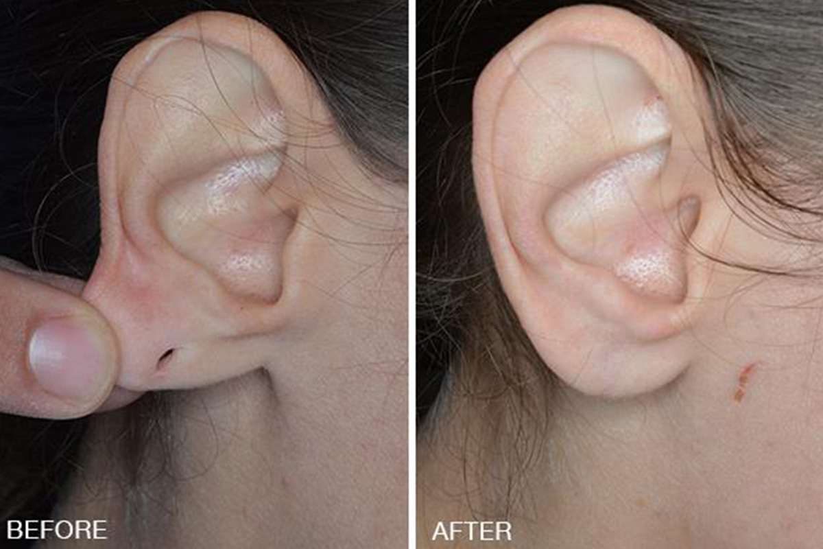 Earlobe Repair London, Ear Rejuvenation Surgery, Split Stretched