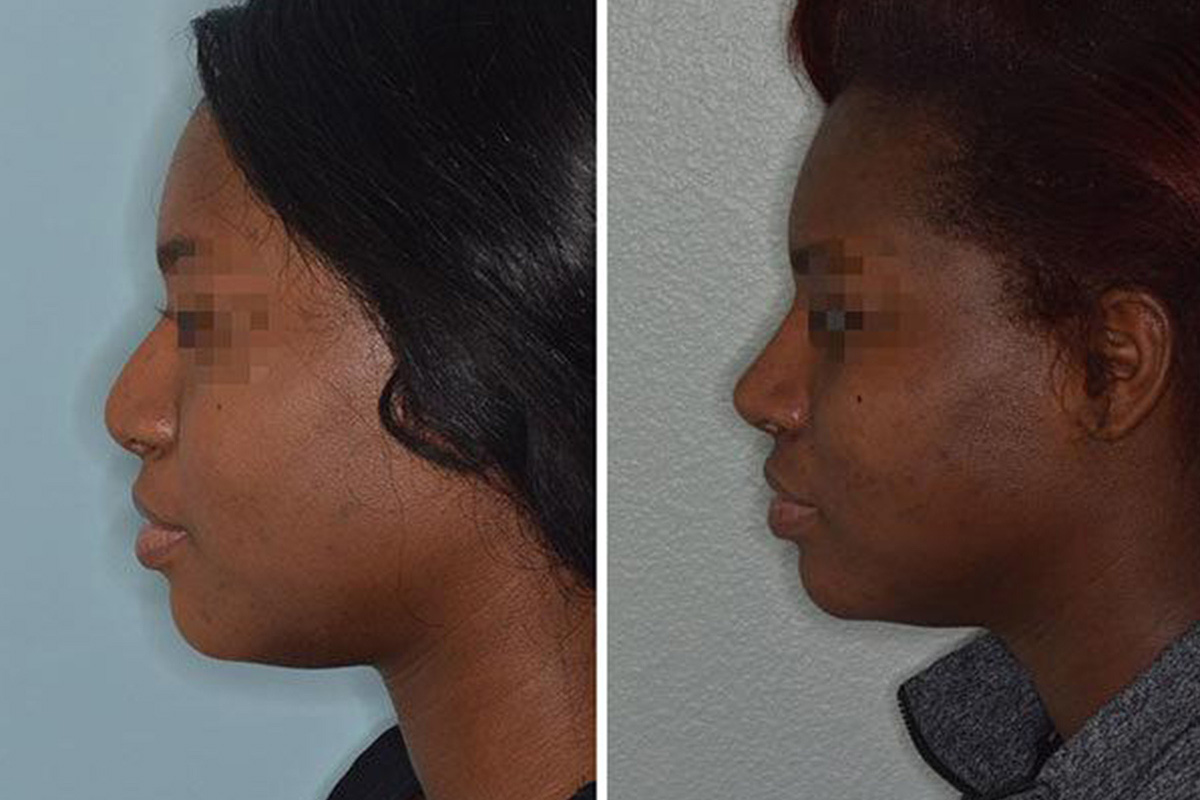 Ethnic Rhinoplasty Houston - African-American, Hispanic, Asian, Middle  Eastern - Funk Facial Plastic Surgery