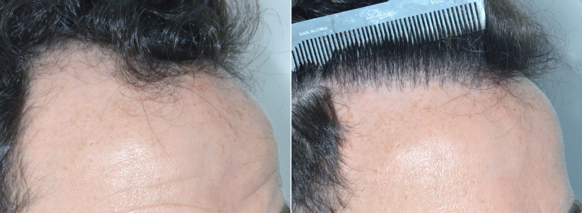 Hair Transplant Before and After Photos in Miami, FL, Patient 3841
