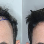 Hair Transplant Before and After Photos in Miami, FL, Patient 3841