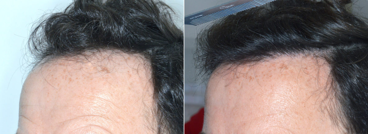 Hair Transplant Before and After Photos in Miami, FL, Patient 3841
