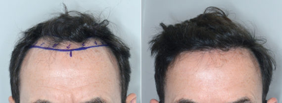 Hair Transplant Before and After Photos in Miami, FL, Patient 3841