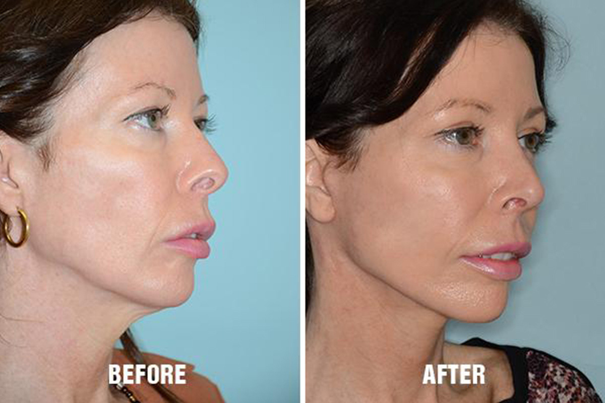 neck lift miami fl anthony bared md f a c s