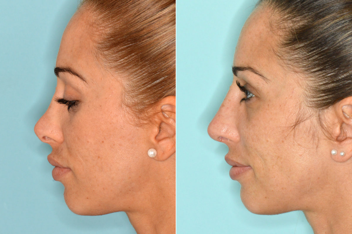 Revision Rhinoplasty Before and After Photos in Miami, FL, Patient 3834