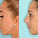 Revision Rhinoplasty Before and After Photos in Miami, FL, Patient 3834