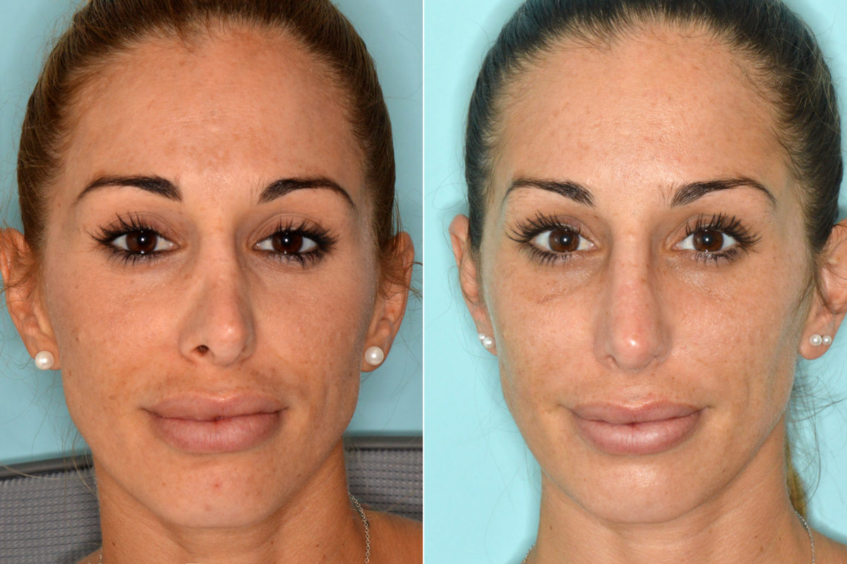 Revision Rhinoplasty Before and After Photos in Miami, FL, Patient 3834