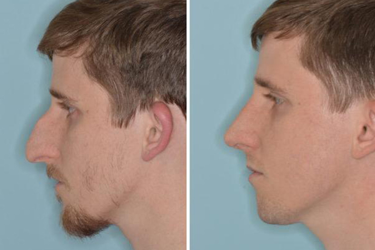 Rhinoplasty Before & After Photos - Yarish Plastic Surgery