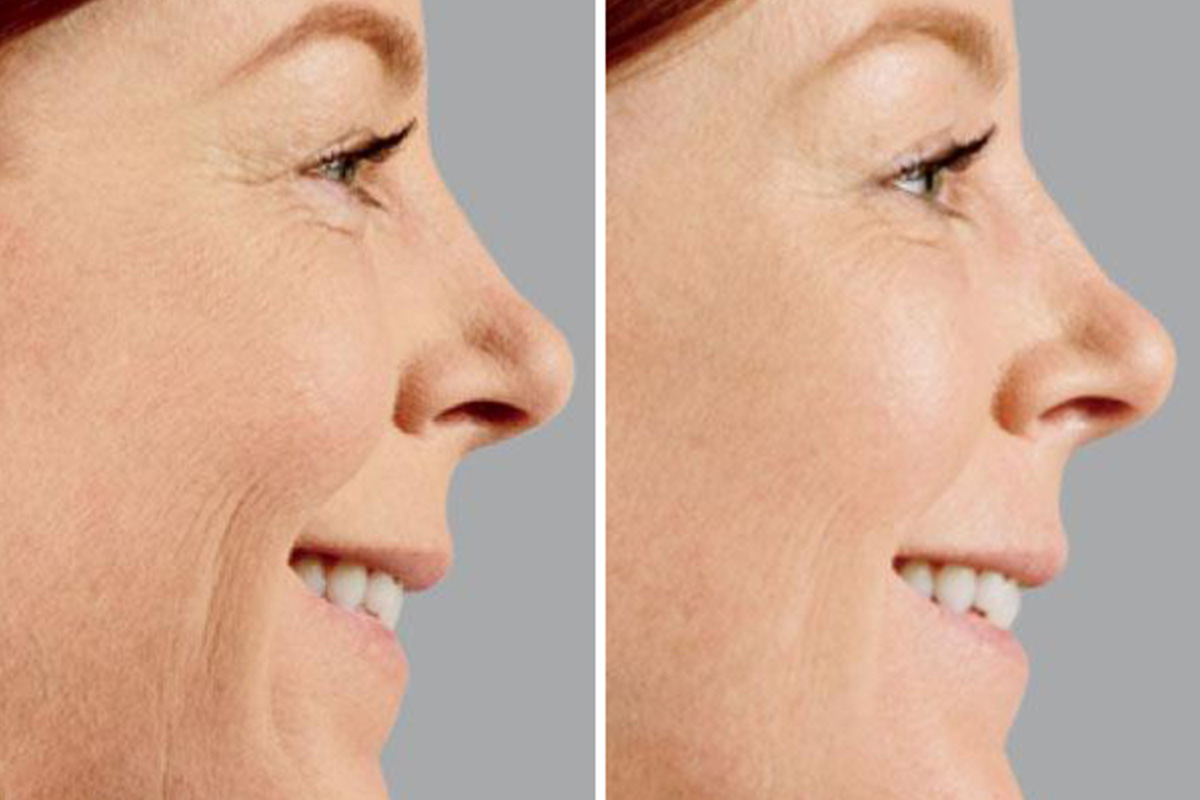 Voluma Miami Volumizing Facial Treatments Florida