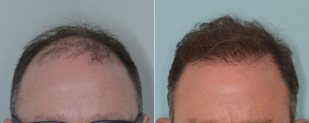 Hair Transplant Before and After Photos in Miami, FL, Patient 3885