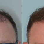 Hair Transplant Before and After Photos in Miami, FL, Patient 3885