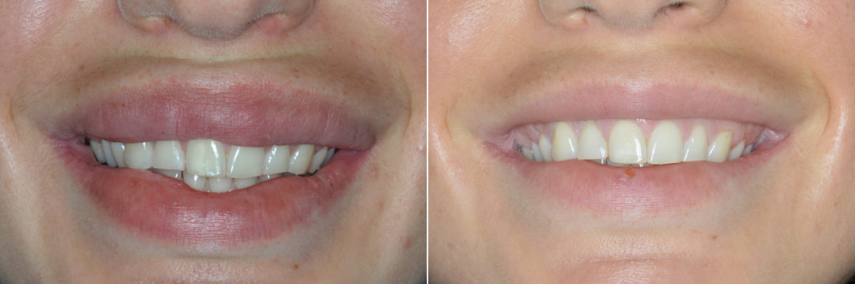 Lip Reduction Before and After Photos in Miami, FL, Patient 4043