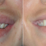 Lip Reduction Before and After Photos in Miami, FL, Patient 4043