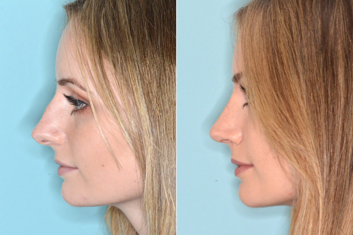 Rhinoplasty Before and After Photos in Miami, FL, Patient 4054