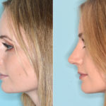 Rhinoplasty Before and After Photos in Miami, FL, Patient 4054