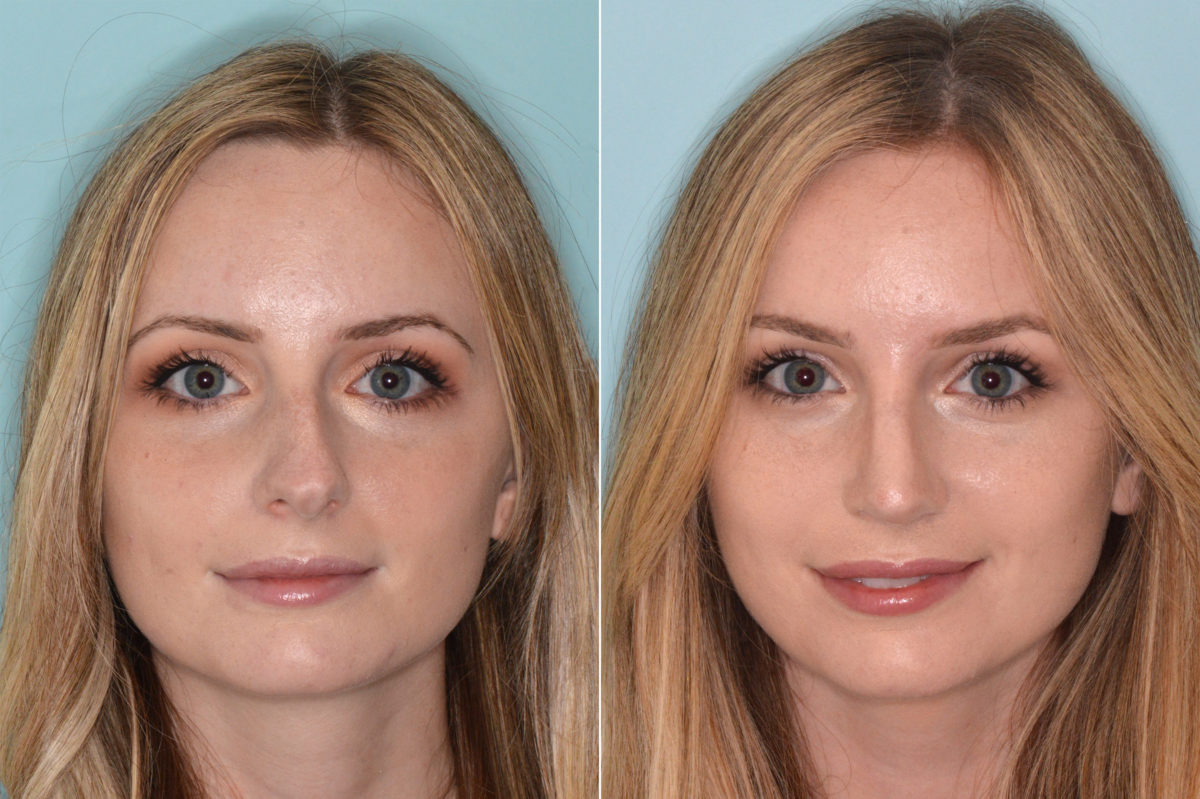 Rhinoplasty Before and After Photos in Miami, FL, Patient 4054