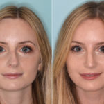 Rhinoplasty Before and After Photos in Miami, FL, Patient 4054