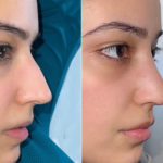 Rhinoplasty Before and After Photos in Miami, FL, Patient 4085