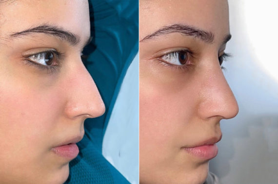 Rhinoplasty Before and After Photos in Miami, FL, Patient 4085