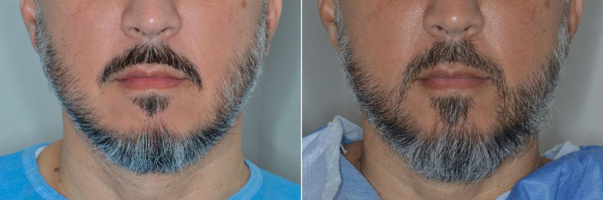 Hair Restoration Before and After Photos in Miami, FL, Patient 4121