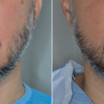 Hair Restoration Before and After Photos in Miami, FL, Patient 4121