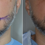 Hair Restoration Before and After Photos in Miami, FL, Patient 4121