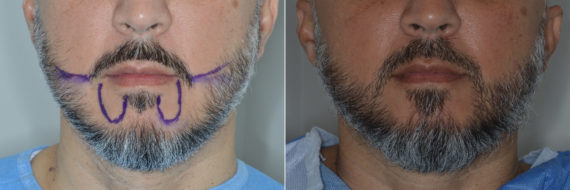 Hair Restoration Before and After Photos in Miami, FL, Patient 4121