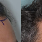 Hair Transplant Before and After Photos in Miami, FL, Patient 4178