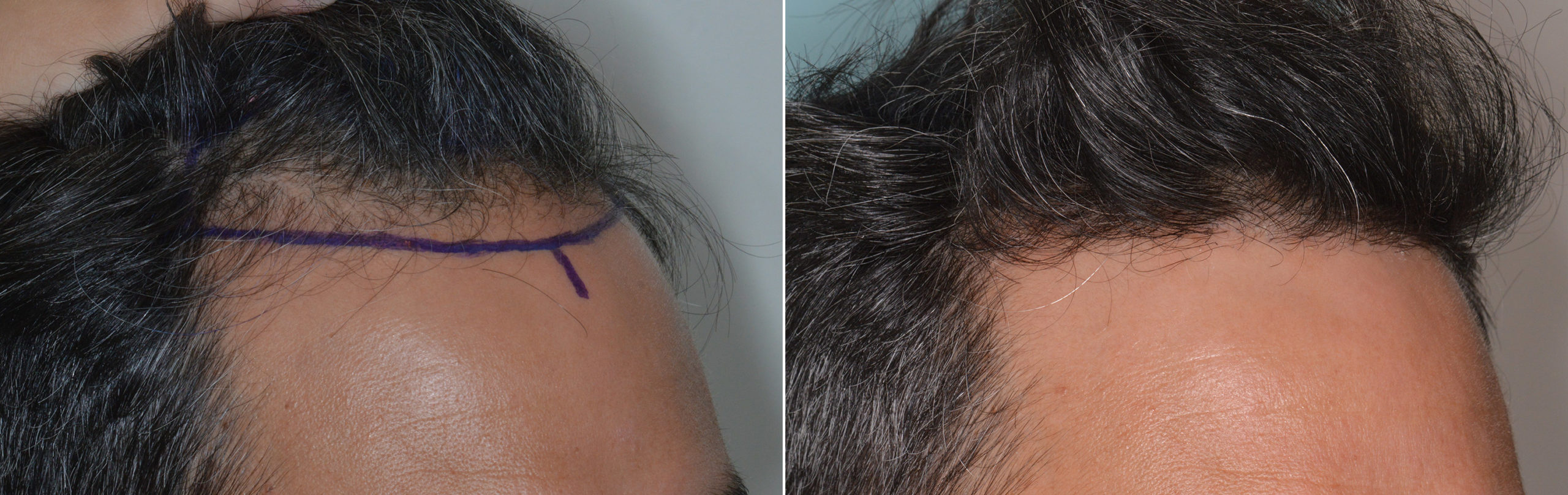 Hair Transplant Photos | Miami, FL | Patient 4178