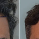 Hair Transplant Before and After Photos in Miami, FL, Patient 4178