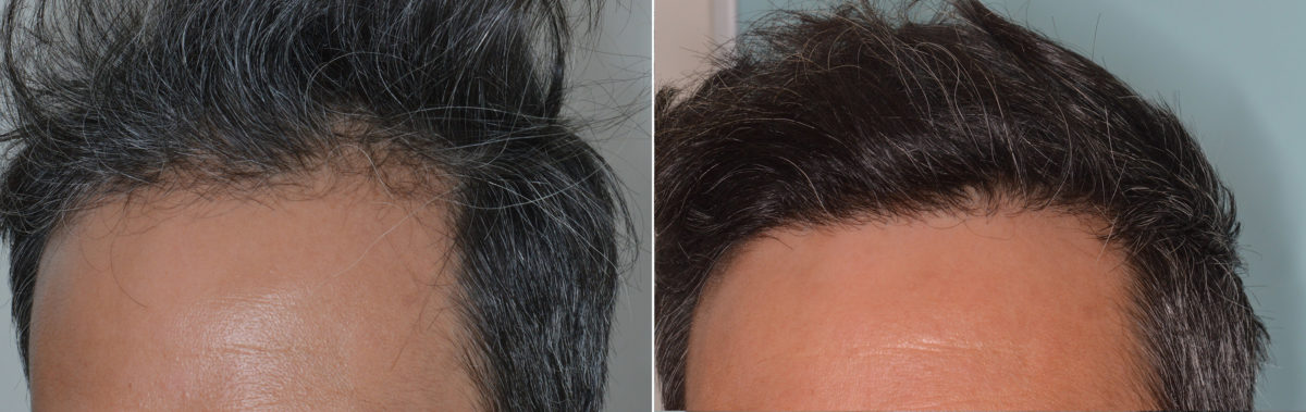 Hair Transplant Before and After Photos in Miami, FL, Patient 4178