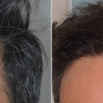 Hair Transplant Before and After Photos in Miami, FL, Patient 4178