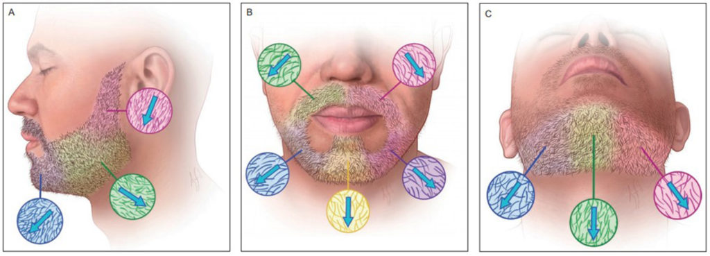 When removing hair, it is crucial to do so strategically because it will not regrow in the donor area