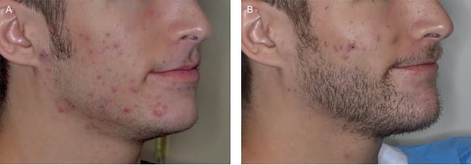 FTM Transgender Beard Transplantation