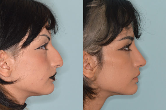 Rhinoplasty Before and After Photos in Miami, FL, Patient 4318