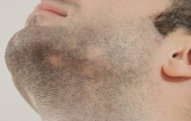  Beard Transplant options may include filling in thin or bare areas in a man's beard.