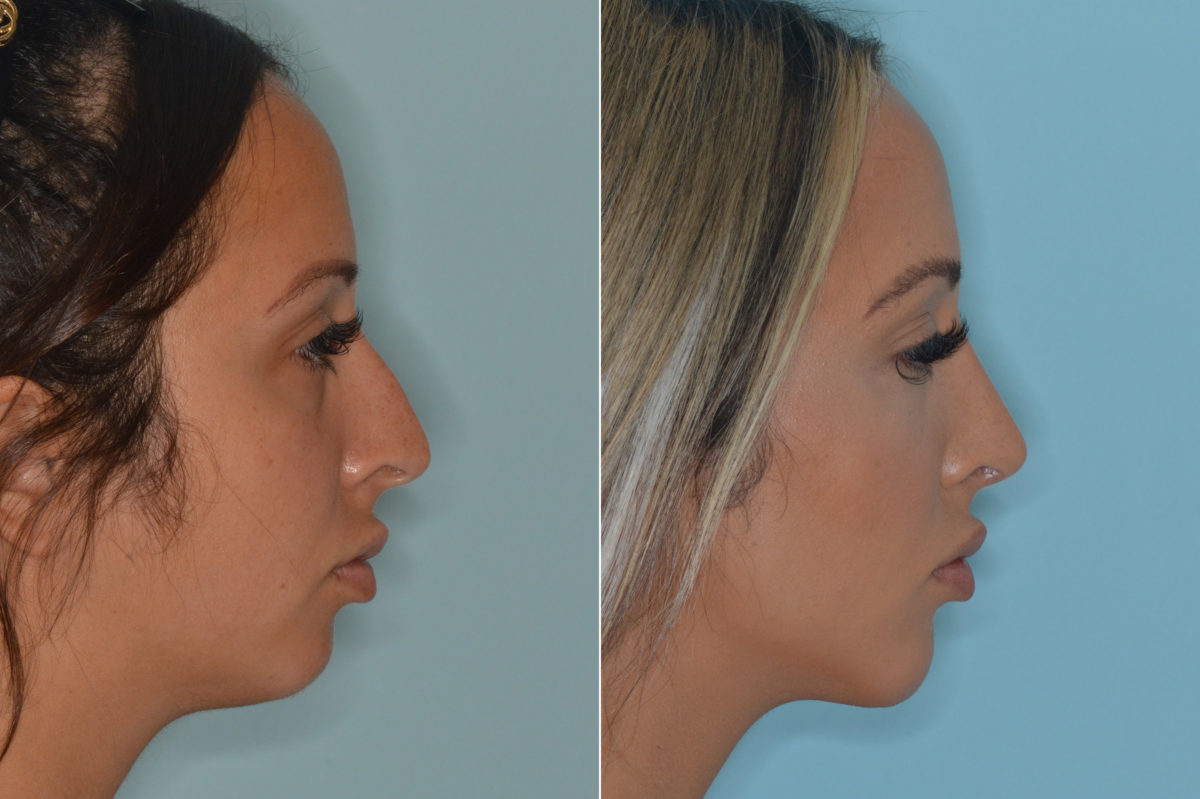 Rhinoplasty Before and After Photos in Miami, FL, Patient 4432