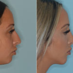 Rhinoplasty Before and After Photos in Miami, FL, Patient 4432