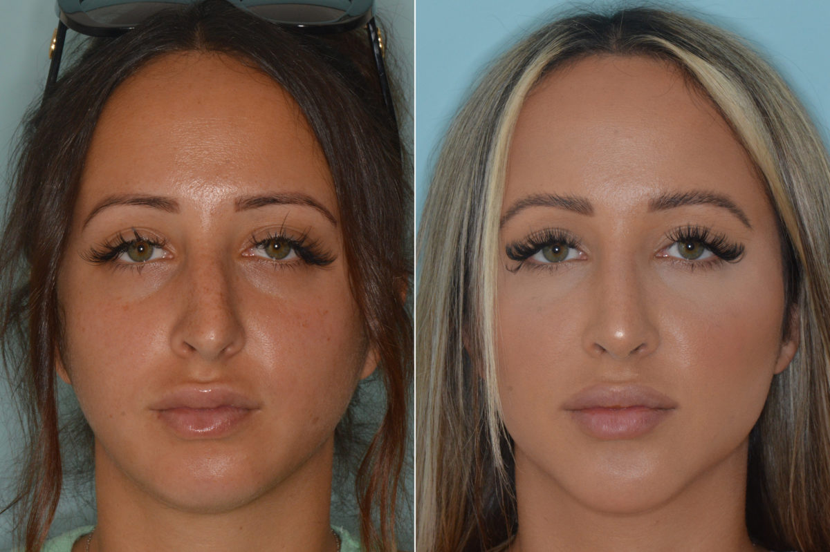 Rhinoplasty Before and After Photos in Miami, FL, Patient 4432