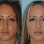 Rhinoplasty Before and After Photos in Miami, FL, Patient 4432